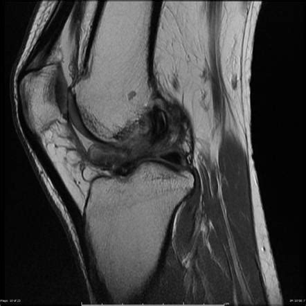 Cyclops Lesion Knee Radiology Reference Article Radiopaedia Org