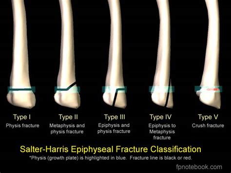 Fracturedislocationsublaxation Anatomy For Msp