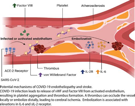 Ischemic Stroke Inflammation And Endotheliopathy In Covid Patients