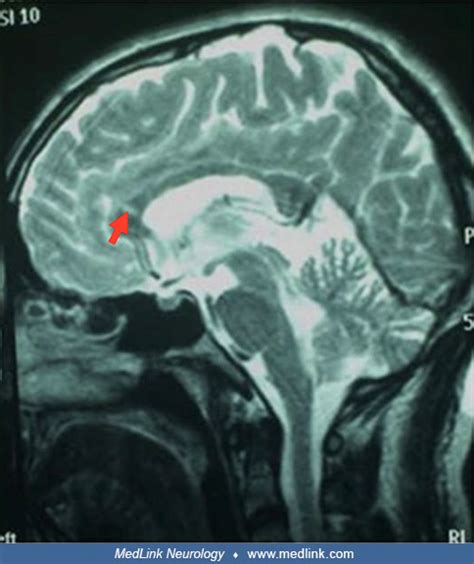 Susac Syndrome Medlink Neurology