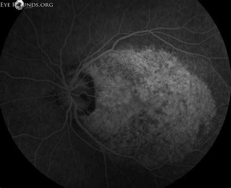 Optic nerve pit maculopathy