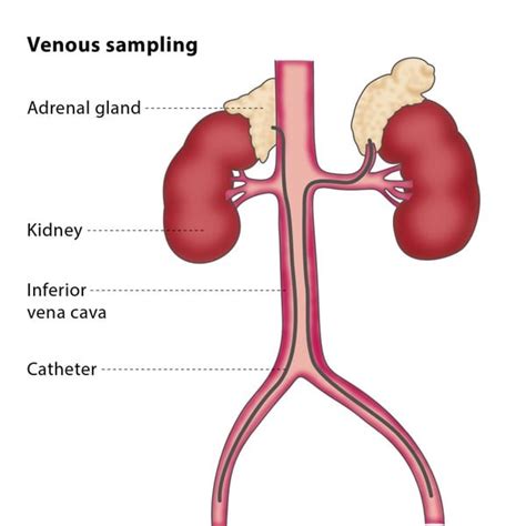 Venous Sampling Cirse