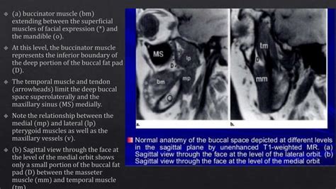 Buccal Space Anatomy Ppt