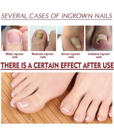 German Toenailcare Removal Paronychia Oil German Bunion Therapy Oil