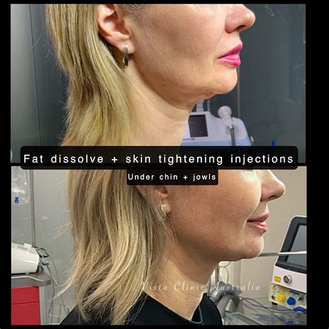 Fat Dissolving Injections For Face Side Effects Store Katutekno