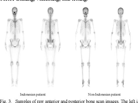 Figure From Whole Body Bone Scan Segmentation Using Segformer