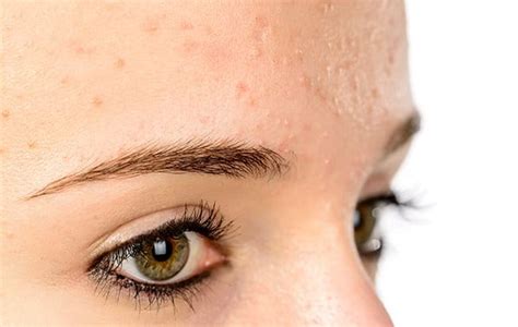 What Are Different Types Of Acne Symptoms Causes And Treatment