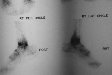 Figure 1 From Ankle Impingement Combined Anterior And Posterior Impingement Syndrome Of The