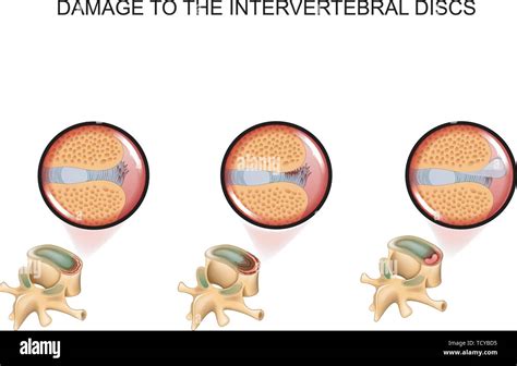 Vector Illustration Of Intervertebral Disc Damage Vertebra Stock