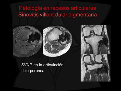 Revisi N Ilustrada De La Patolog A Del Hueco Popl Teo Ppt Video