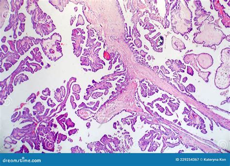 Papillary Thyroid Cancer Light Micrograph Stock Image Image Of