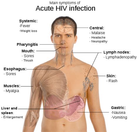 Hivaids Symptoms Causes Transmission Treatment And Prevention Easystd