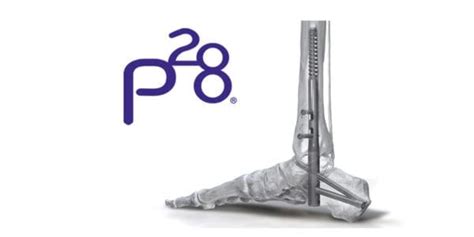 Paragon 28 Launches Phantom Hindfoot TTC TC System ORTHOWORLD