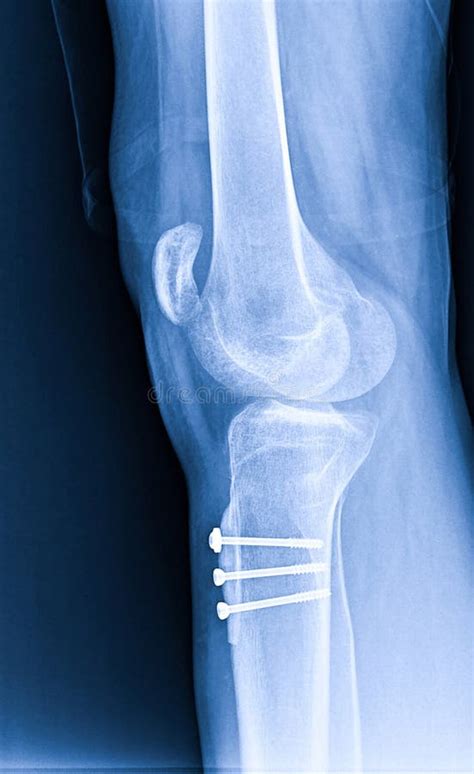 X-ray Knee Joint Fracture Proximal Tibia and Post Fix Fracture Proximal Tibia with Plate and ...