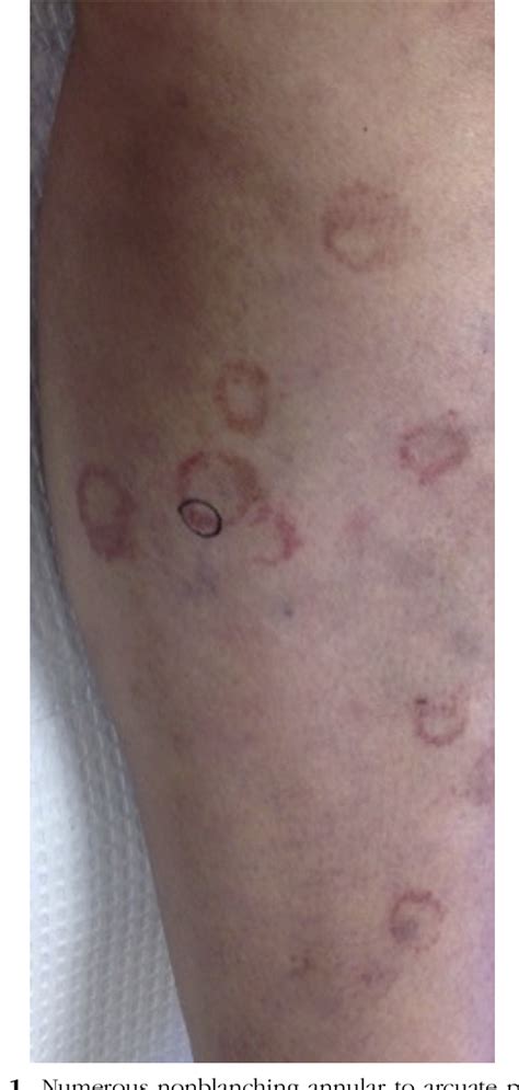 Figure From Sclerotherapy Induced Purpura Annularis Telangiectodes Of