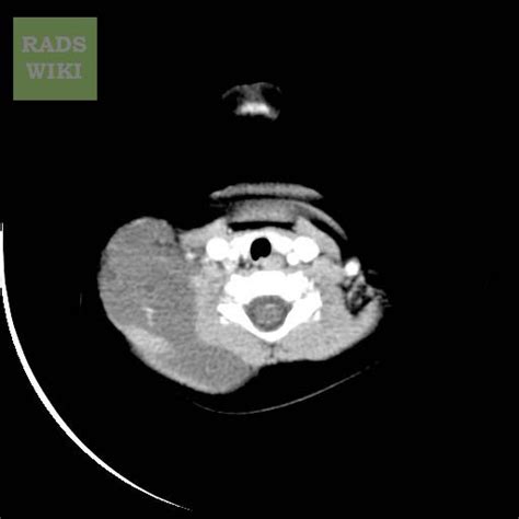 Neck Ct Cystic Hygroma Radrounds Radiology Network