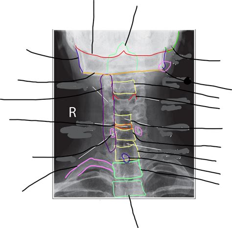 Radiographic Anatomy Ap Axial Cervical Spine Diagram Quizlet