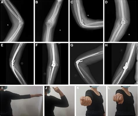 Comparison Of Clinical Outcomes Between The Olecranon Osteotomy