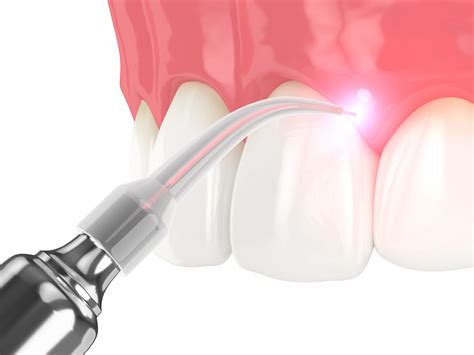 Benefits of Laser Dentistry | Torrey Hills Dental