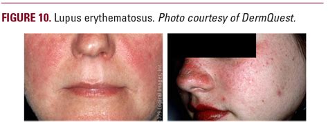 Rosacea Vs Lupus Butterfly Rash