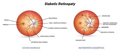 Retinopatia Diabetica Prevenzione