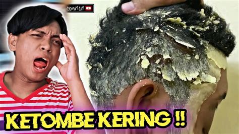 Membersihkan Ketombe Terparah Yang Sudah Jadi Kering Satisfying Youtube