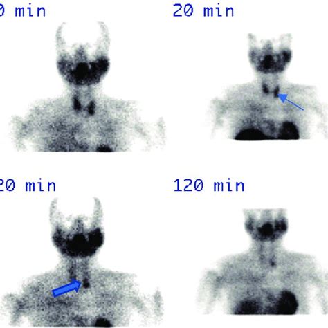 Single Isotope Dual Phase Scintigraphy With M Tc Sestamibi The Late