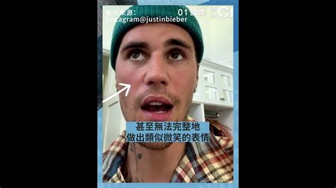 Justin Bieber患上「拉姆齊亨特綜合症」一邊臉癱個唱延遲 Youtube