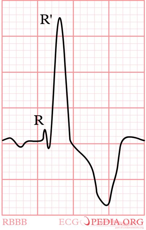 Intraventricular Conduction Hippocrates Guild