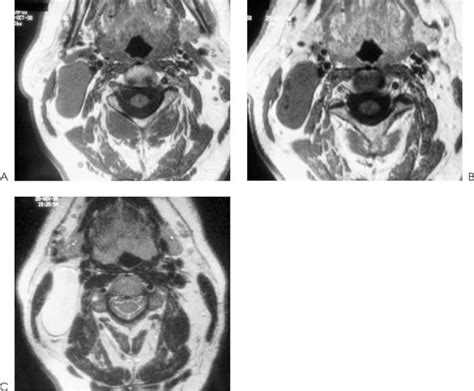 Congenital Anomalies Of The Third Branchial Apparatus Radiology Key