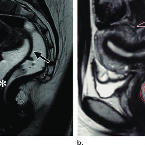 Normal Anatomy Of The Female Pelvis A B Axial A And Sagittal B Images