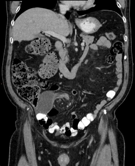 Sigmoid Volvulus Image