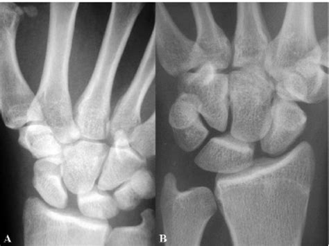 Scapholunate Dislocation