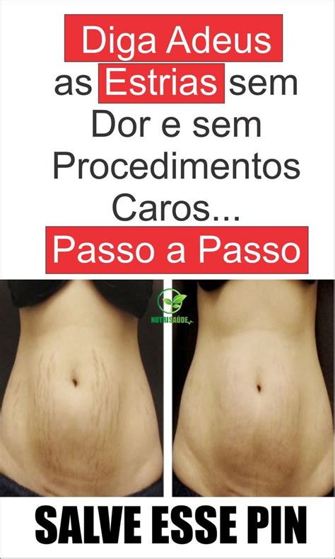 Como Se Livrar Das Estrias Em 15 Minutos Passo A Passo Speedo Swimwear