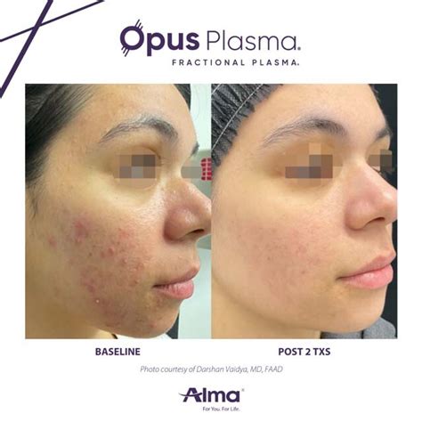 Opus Plasma Skin Tightening Gallery The Beauty Spot In Boulder Colorado