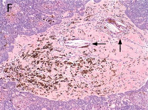 A A Nodular Well Circumscribed Basophilic Tumor Involved The Dermis