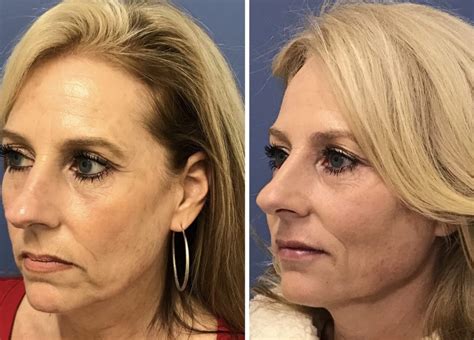 Dermal Fillers Can Lift And Contour Renew Aesthetic