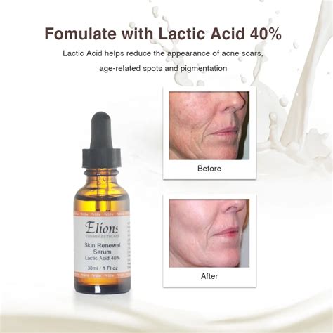 Minimizing Areas Of Discoloration 40 Lactic Acid Increase Collagen