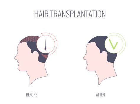 Hair Transplant Illustrations Royalty Free Vector Graphics And Clip Art