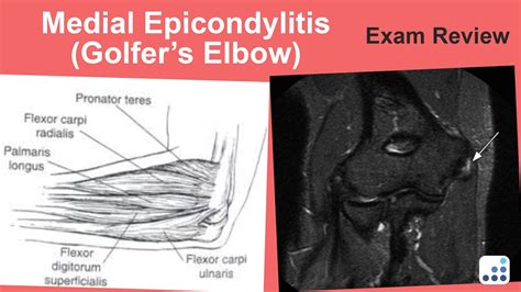 Medial Epicondylitis Golfers Elbow Exam Review Christopher S Ahmad Md Youtube