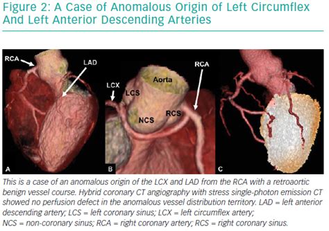 Multimodal Assessment Of Anomalous Right Coronary Artery 40 OFF