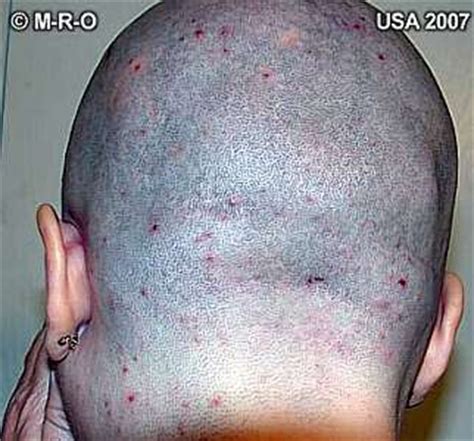 Morgellons skin symptoms