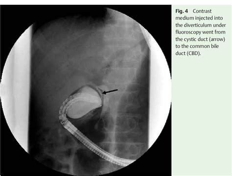 Figure 4 From Gallbladder Polyp Treated With Endoscopic Polypectomy