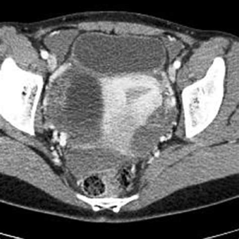 Computed tomography image shows ruptured corpus luteum cyst of right... | Download Scientific ...