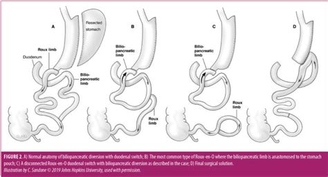 Roux En O After Duodenal Switch A Case Report Bariatric Times