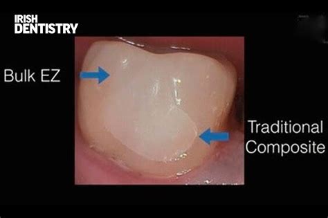 Polymerisation Shrinkage With Bulkfill Composites Irish Dentistry