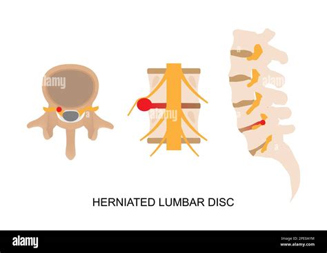 Lumbar Disc Herniation Cut Out Stock Images And Pictures Alamy