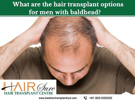 What Are The Hair Transplant Options For Men With A Bald Head