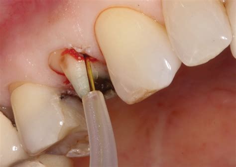 Dental Gingival Retraction Cord What It Is And Why We Use Off