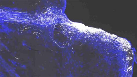 Drug Cocktail Could Restore Vision In Optic Nerve Injury
